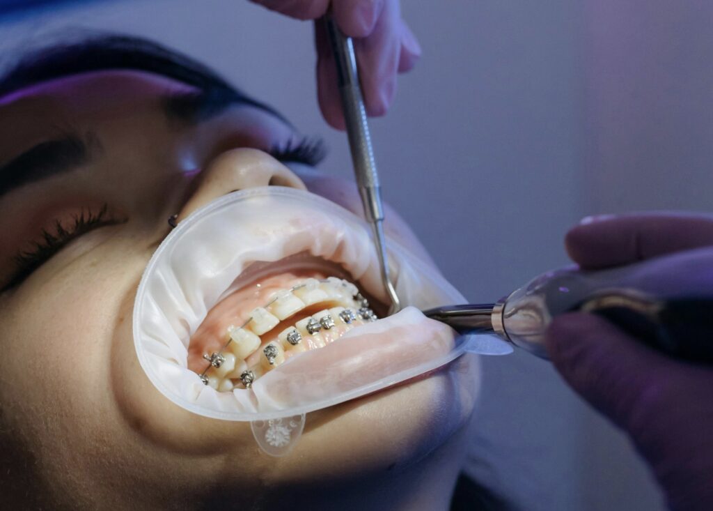 image of an undergoing Orthodontic Treatment using Brackets