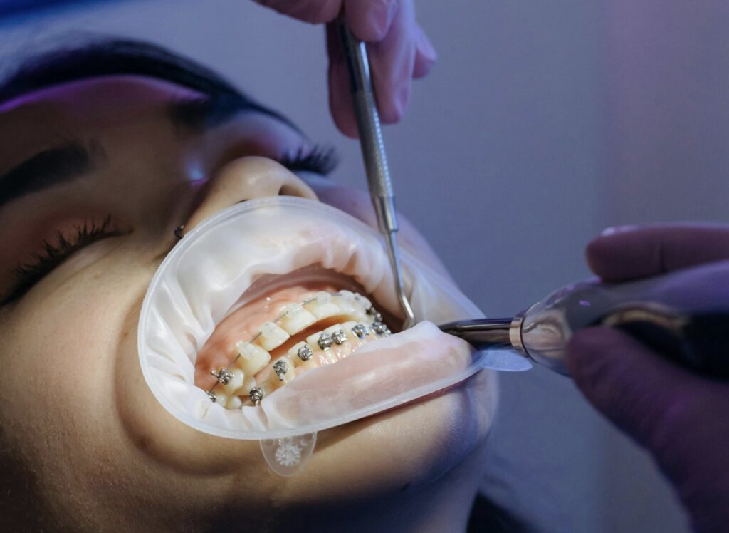 Image off an Orthodontic Treatment Using Brackets