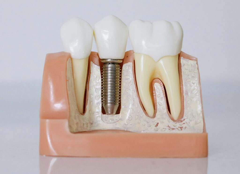 Detailed image of a Dental Implant