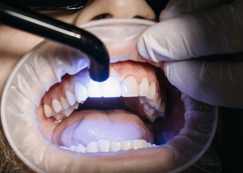 Fluoride Treatment Procedure