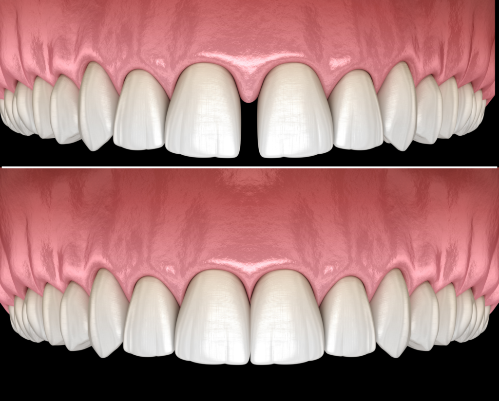 Midline Space Closure using Tooth Coloured Filling Material