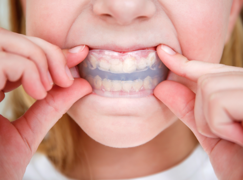 An Appliance called Mouth Guard, custom made to protect teeth
