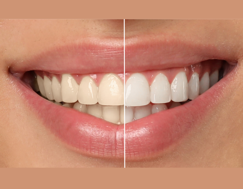 Image showing Before & After of Teeth Whitening Treatment
