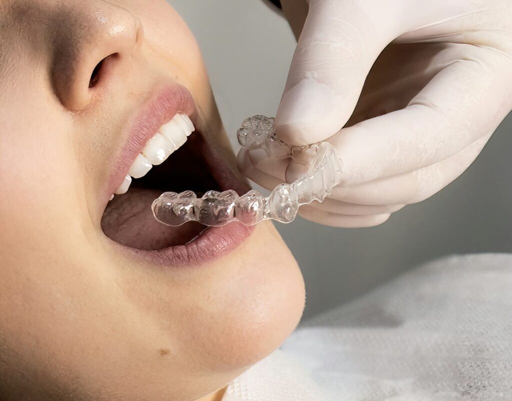 Clear Aligner Tray