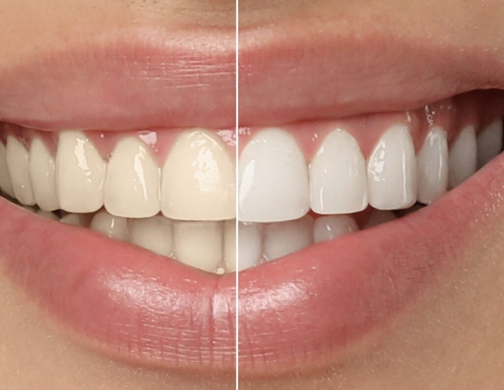 A smiling face with brightened teeth